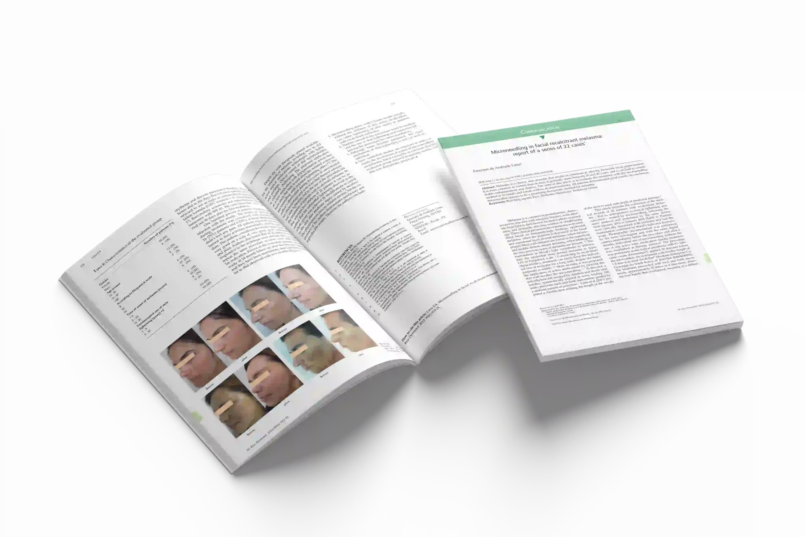 Microneedling in facial recalcitrant melasma: report of a series of 22 cases