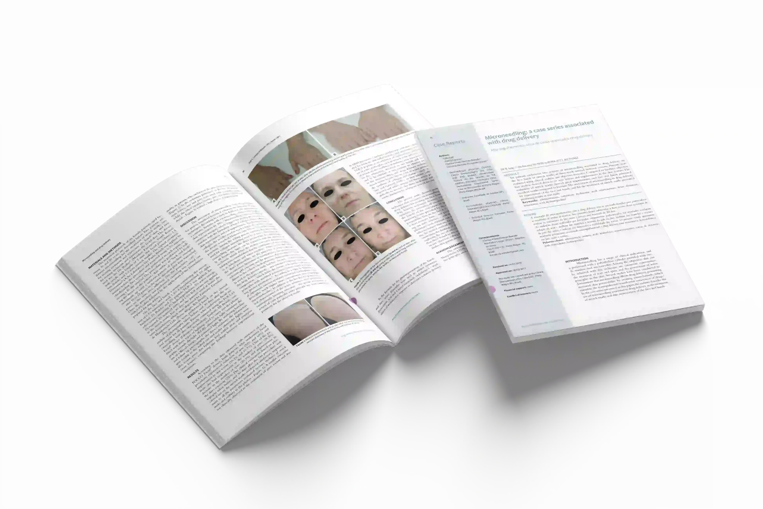 Microneedling: a case series associated with drug delivery