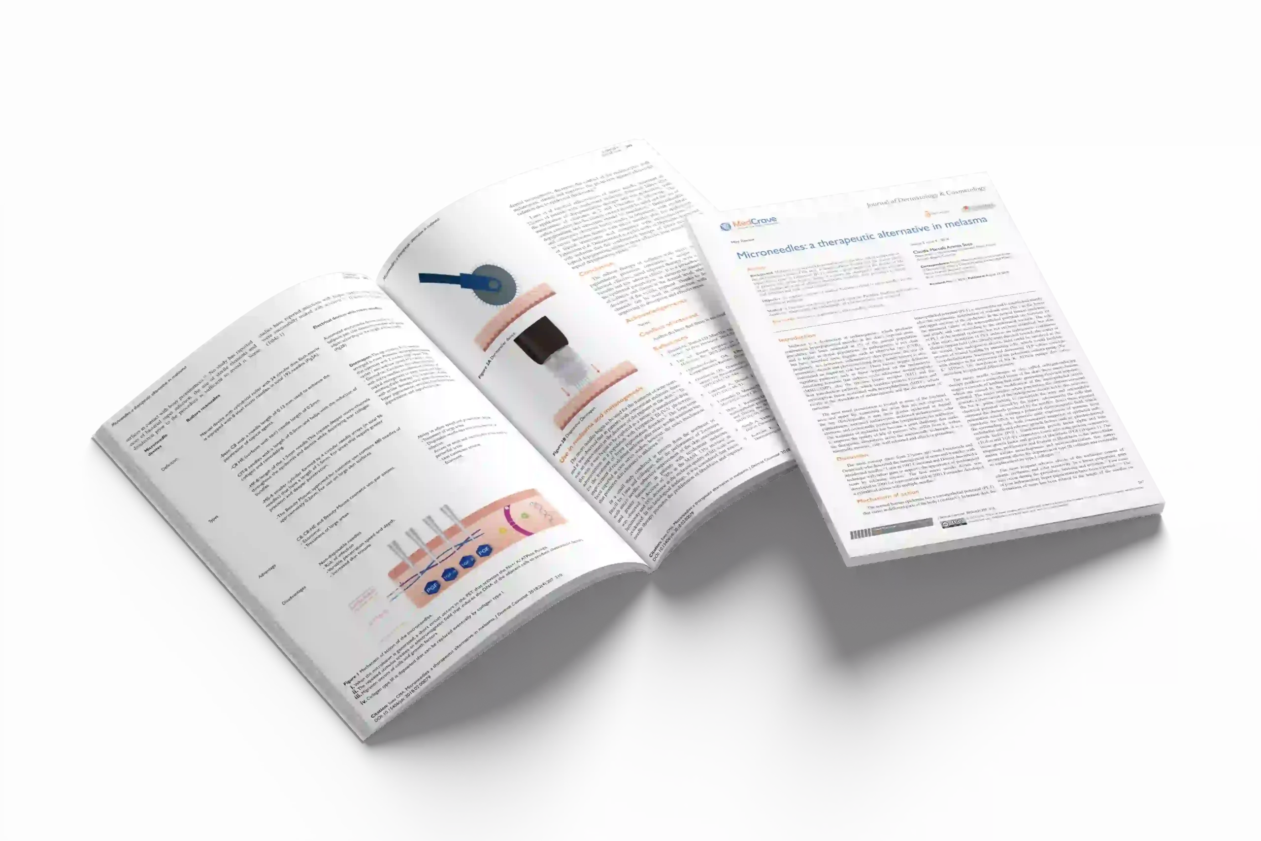 Microneedles: a therapeutic alternative in melasma