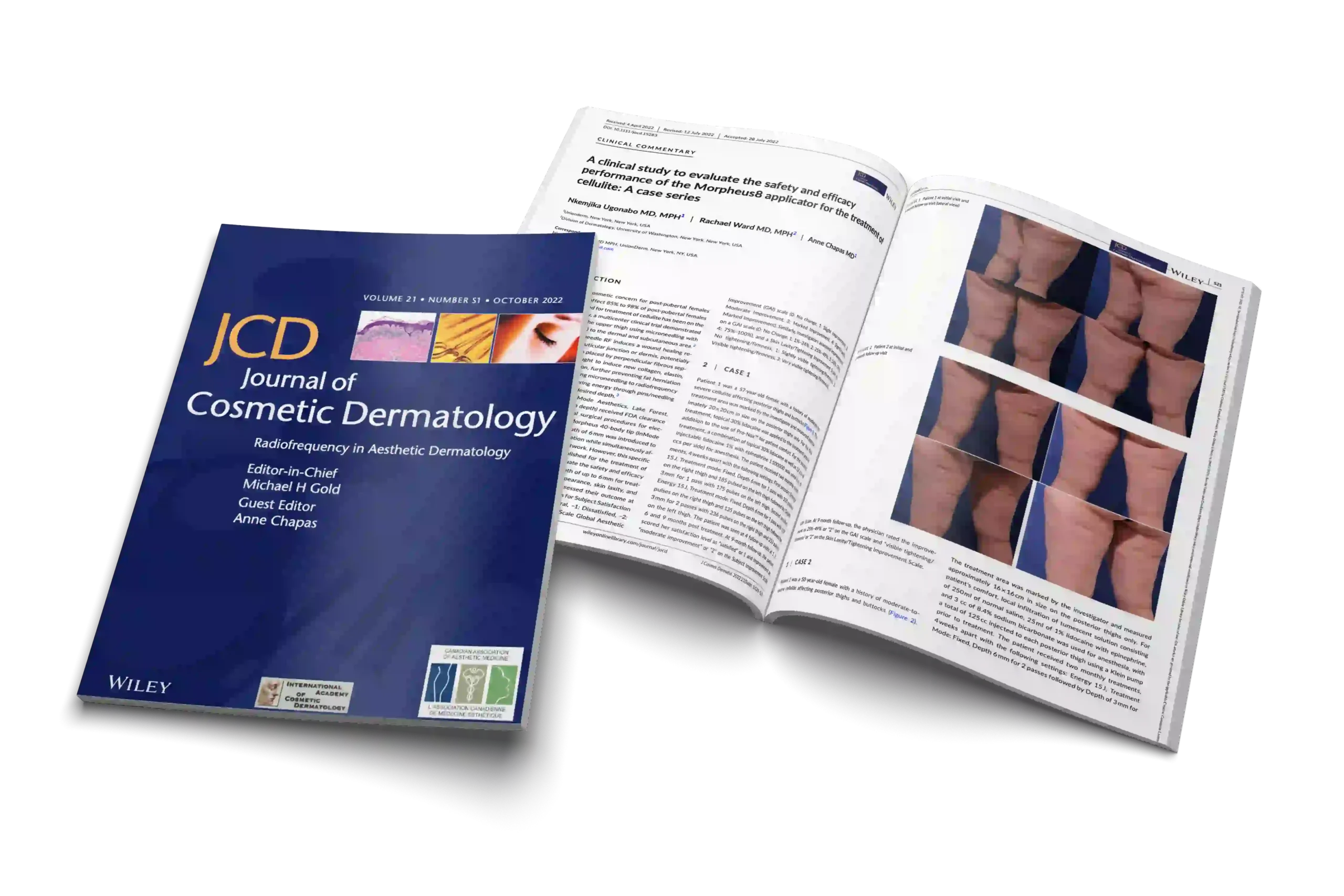 A clinical study to evaluate the safety and efficacy performance of the Morpheus8 applicator for the treatment of cellulite: A case series