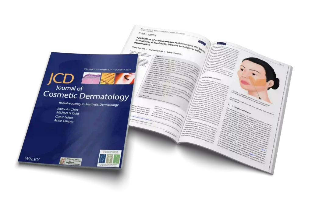 Application of subcutaneous radiofrequency after liposuction on midface: A minimally invasive technique for midface rejuvenation