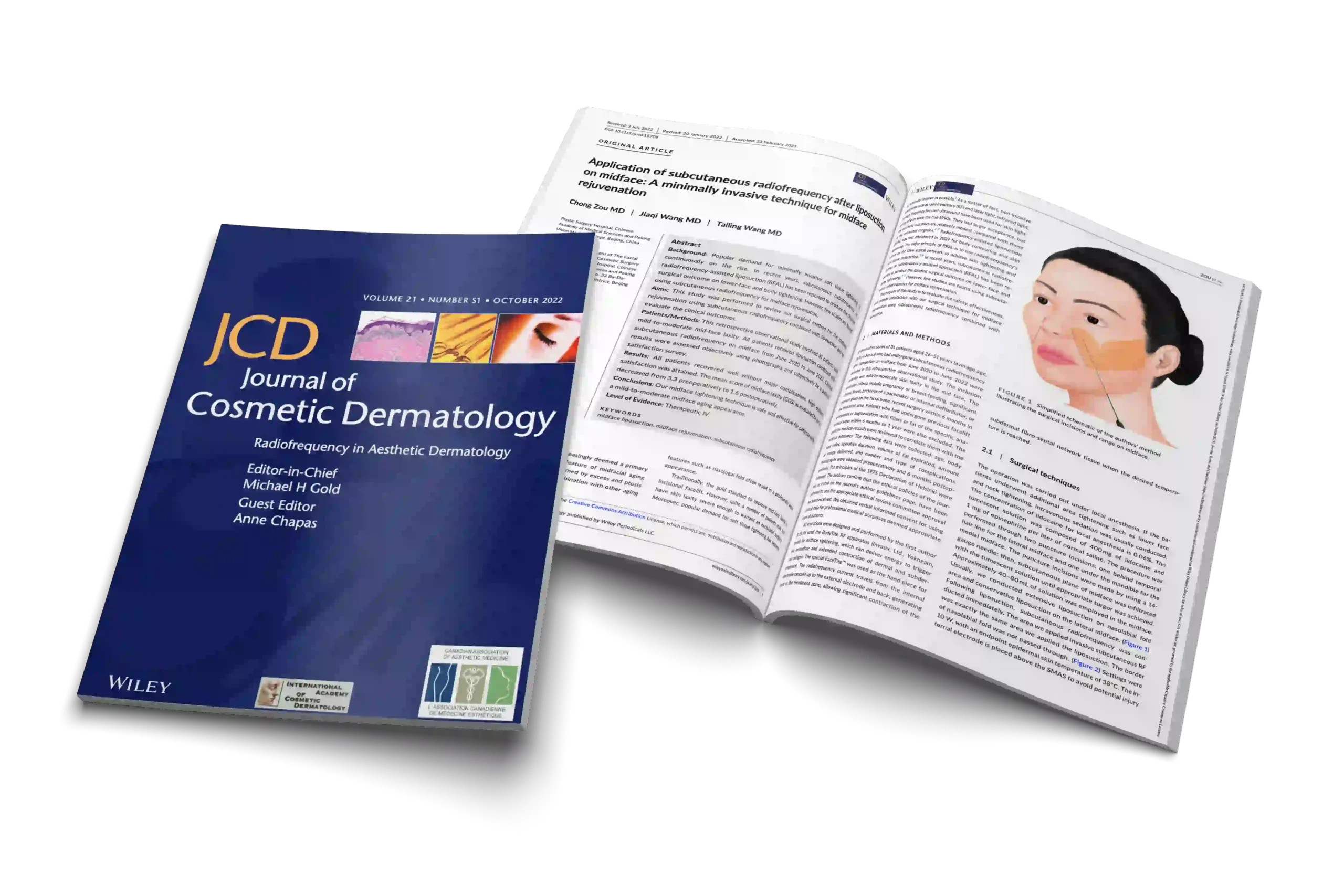 Application of subcutaneous radiofrequency after liposuction on midface: A minimally invasive technique for midface rejuvenation