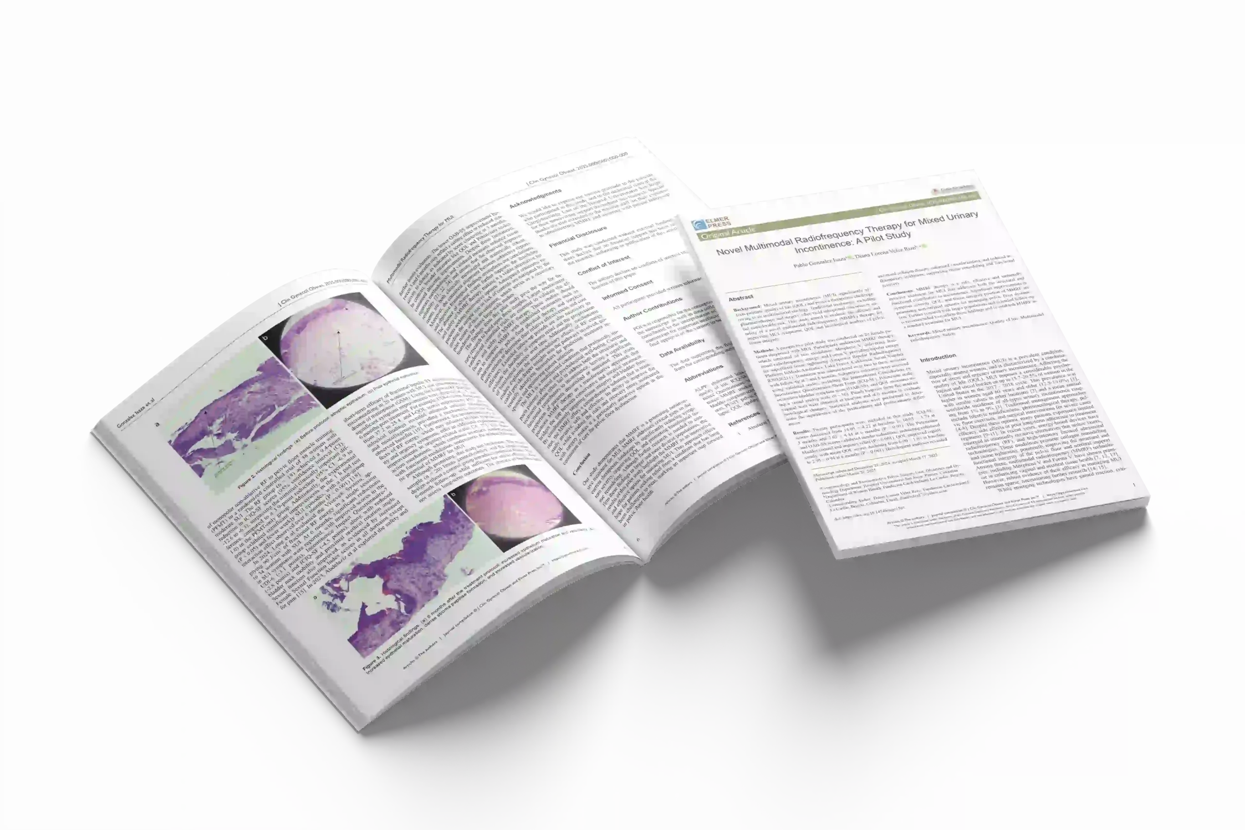 Novel Multimodal Radiofrequency Therapy for Mixed Urinary Incontinence: A Pilot Study