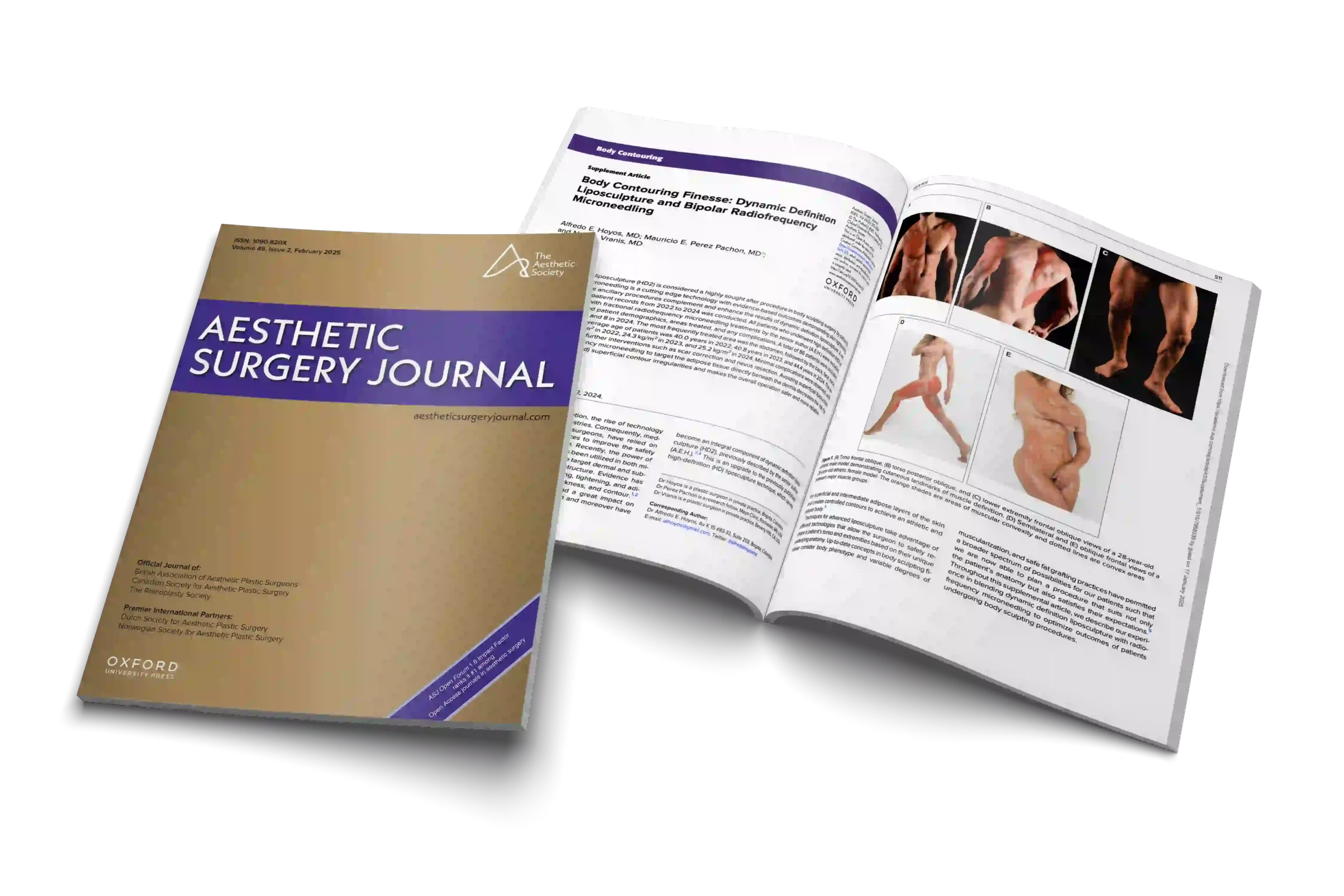 Body Contouring Finesse: Dynamic Definition Liposculpture and Bipolar Radiofrequency Microneedling