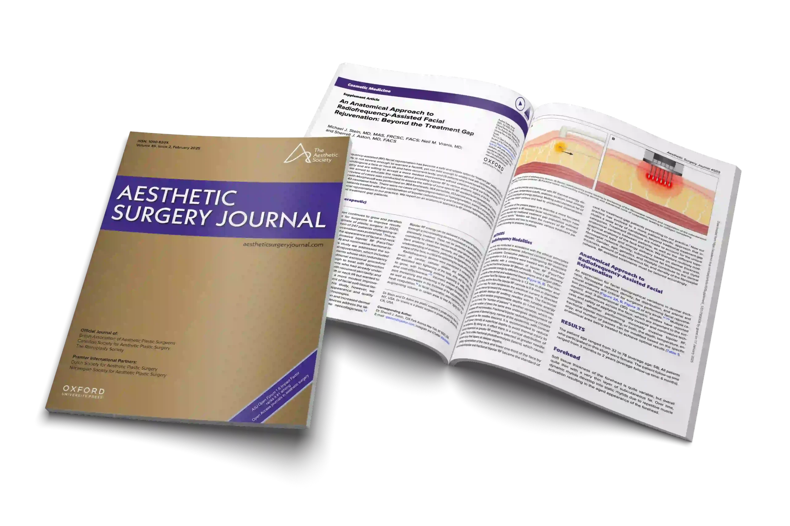 An Anatomical Approach to Radiofrequency-Assisted Facial Rejuvenation: Beyond the Treatment Gap