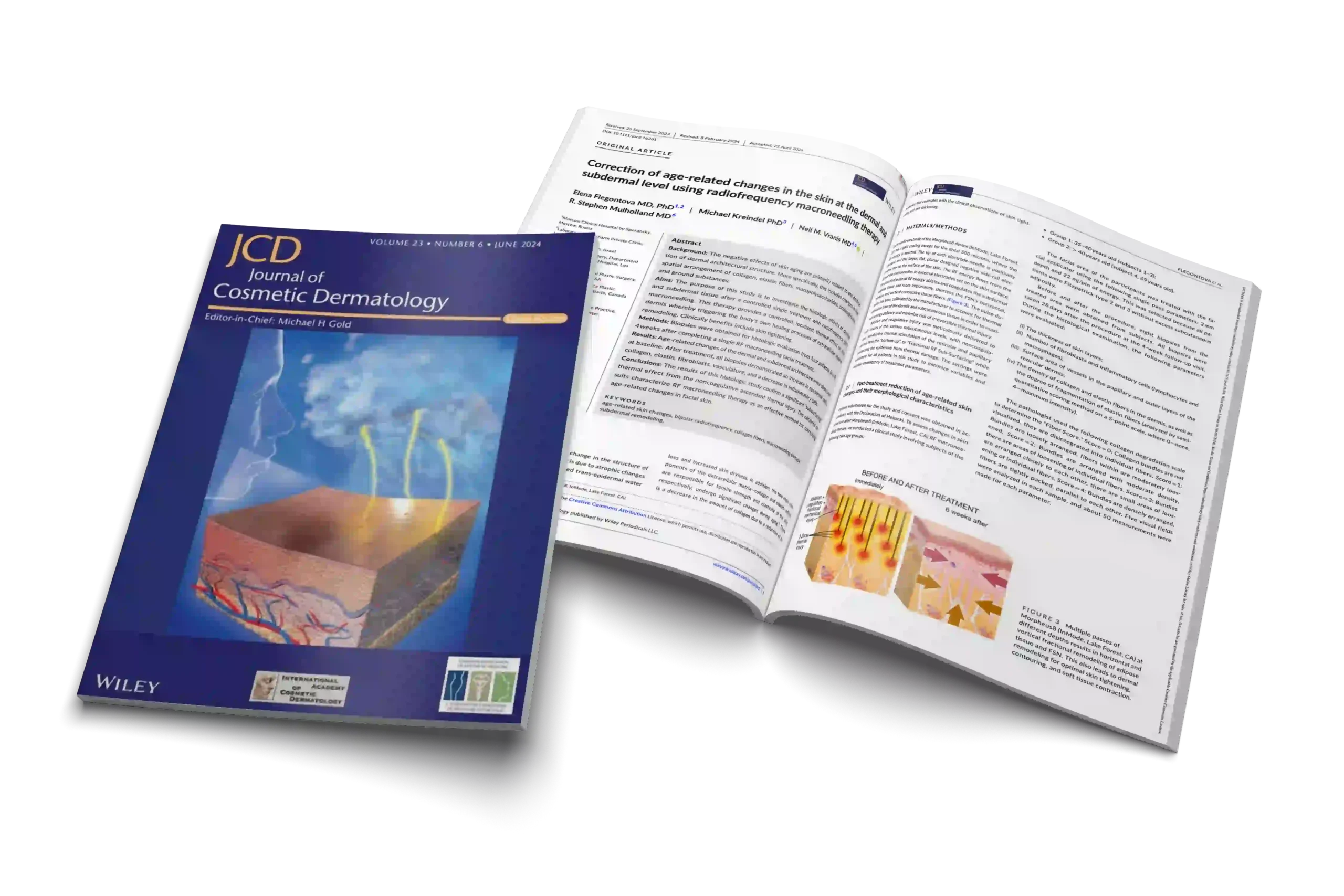 Correction of age-related changes in the skin at the dermal and subdermal level using radiofrequency macroneedling therapy