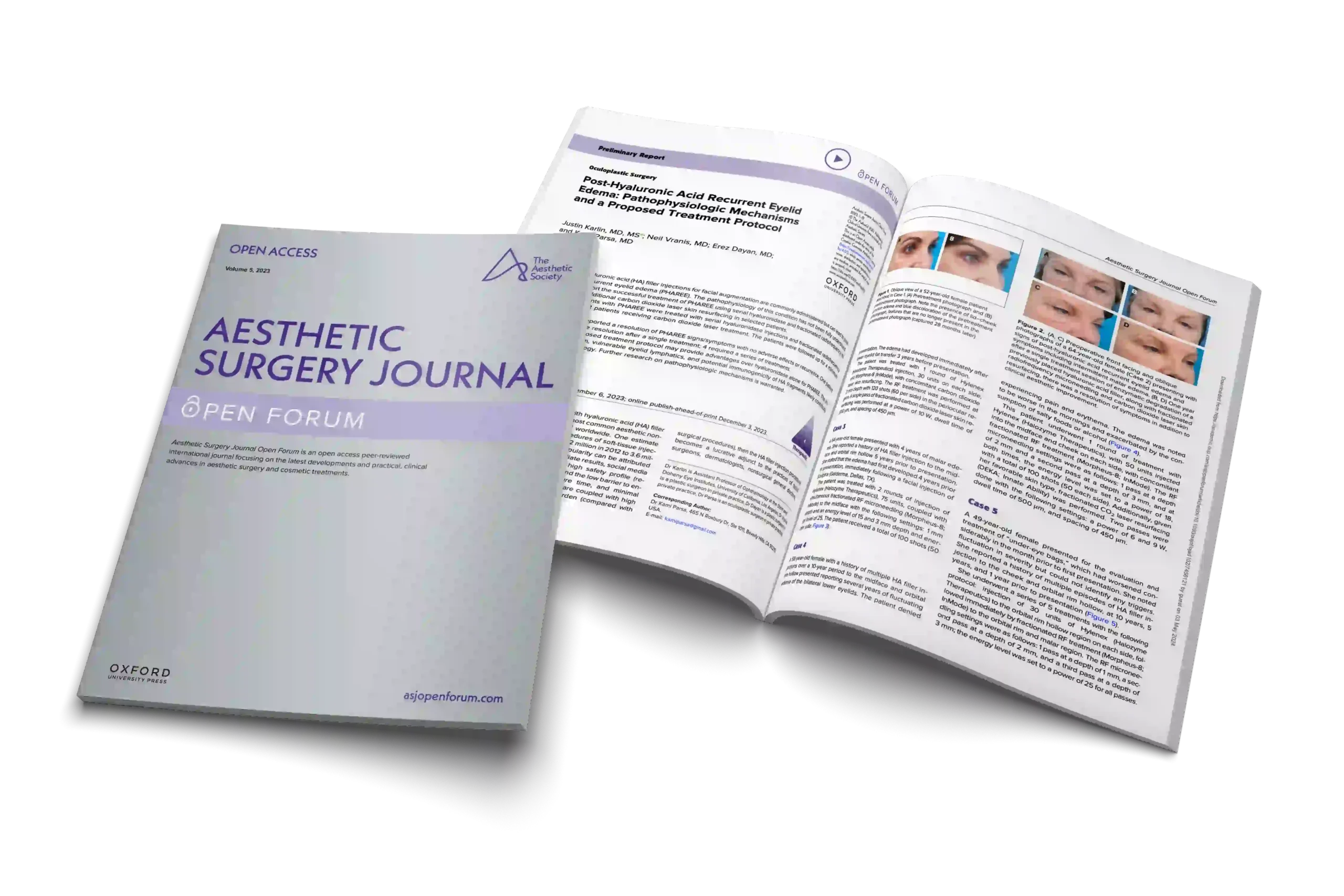 Post-Hyaluronic Acid Recurrent Eyelid Edema: Pathophysiologic Mechanisms and a Proposed Treatment Protocol