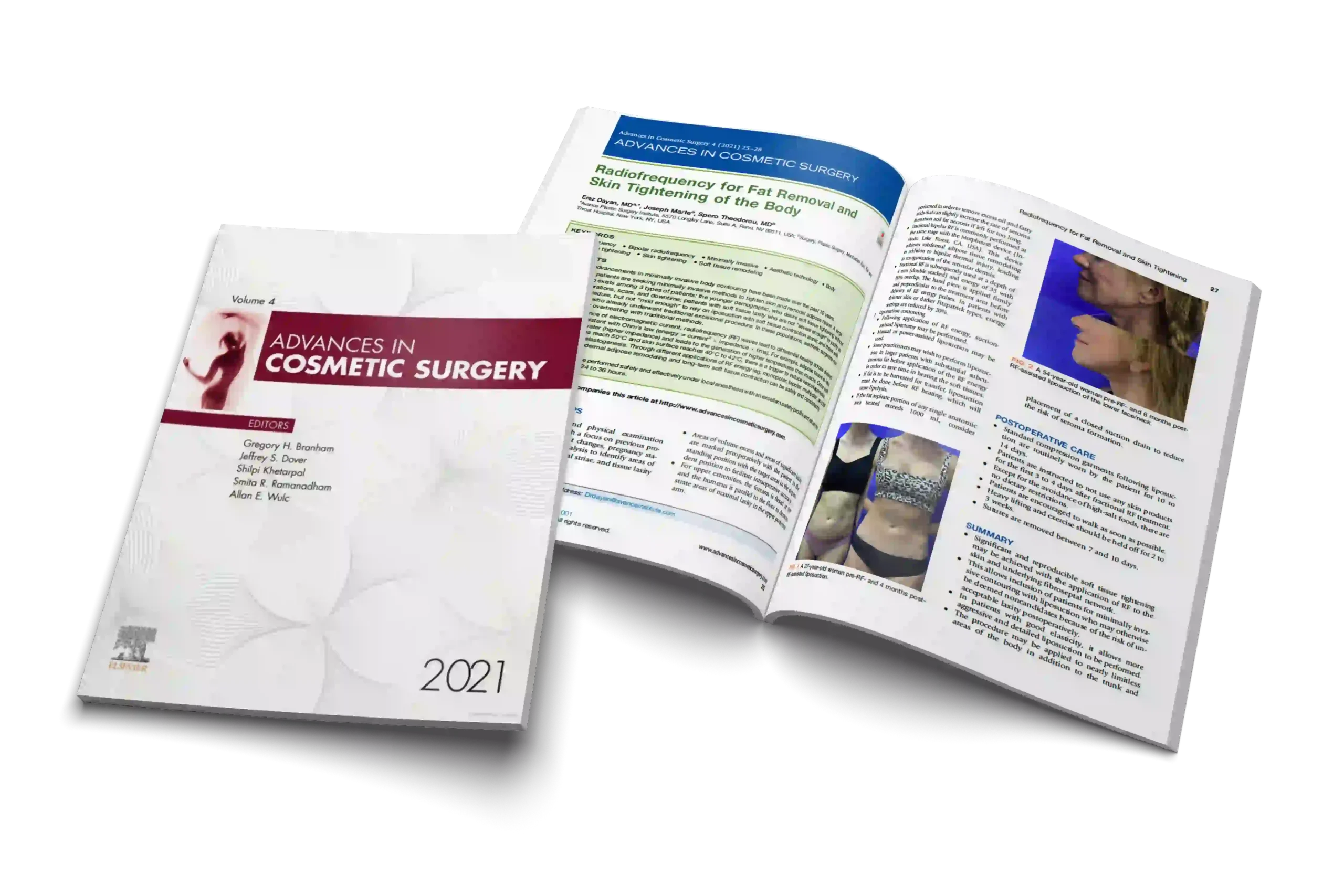 Radiofrequency for Fat Removal and Skin Tightening of the Body